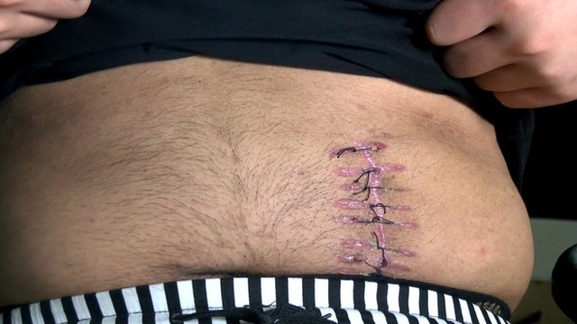 Stitches of man who sold his kidney
