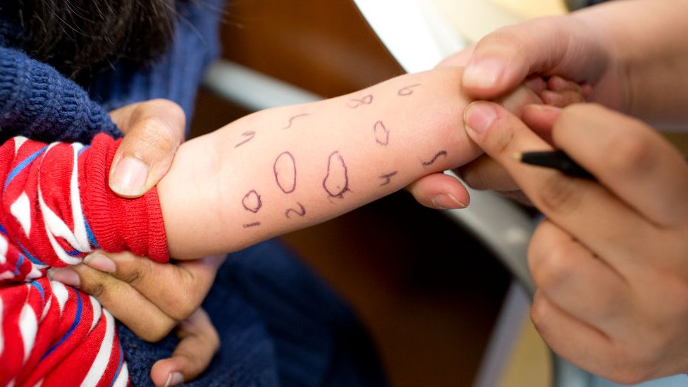 A child being tested for different allergies