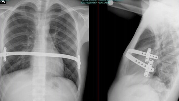 Рентген грудной клетки показывает корсет