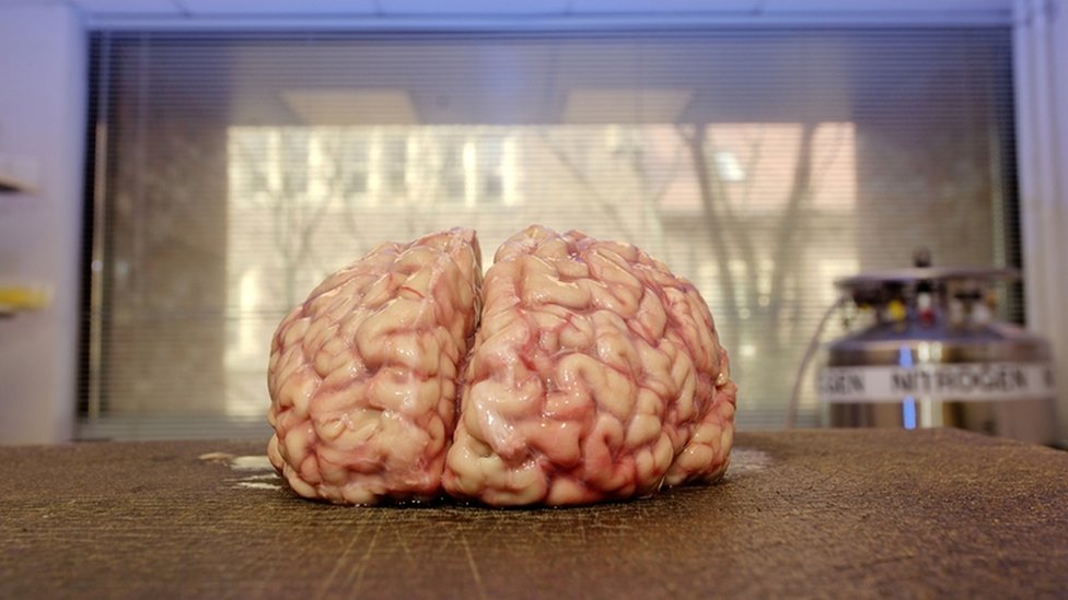 Cerebro humano donado al centro de investigación de cerebro y tejidos de Harvard.