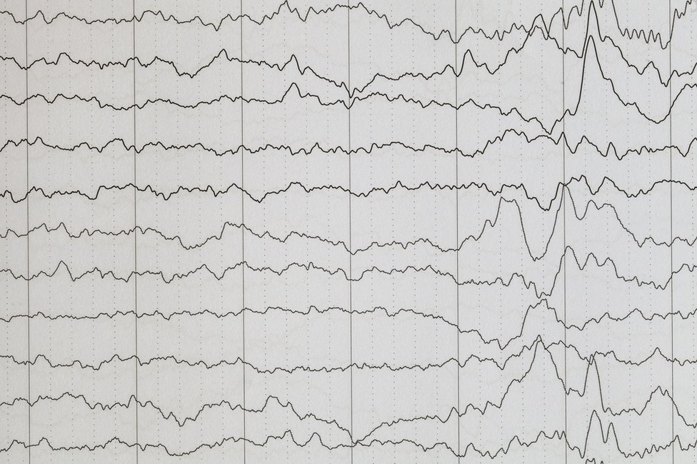 Durante la fase REM del sueño la actividad del cerebro es muy alta. Ondas cerebrales en un electroencefalograma.