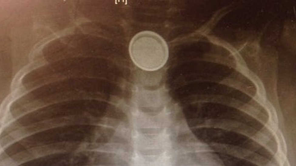 Рентгеновский снимок кнопочной батареи пищевода