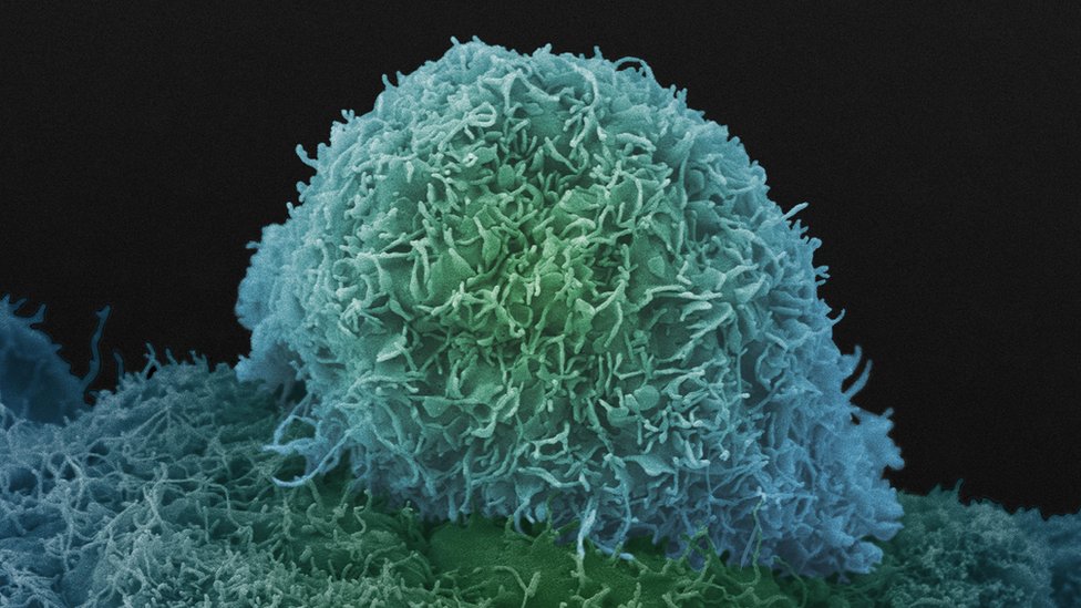 Célula de cáncer de próstata