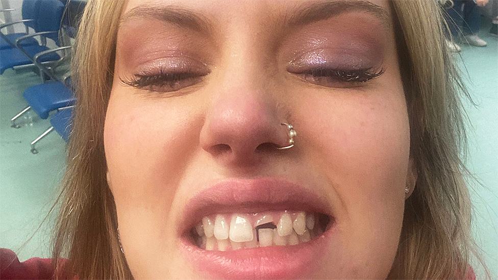 Selfie de Reegan mostrando su diente quebrado