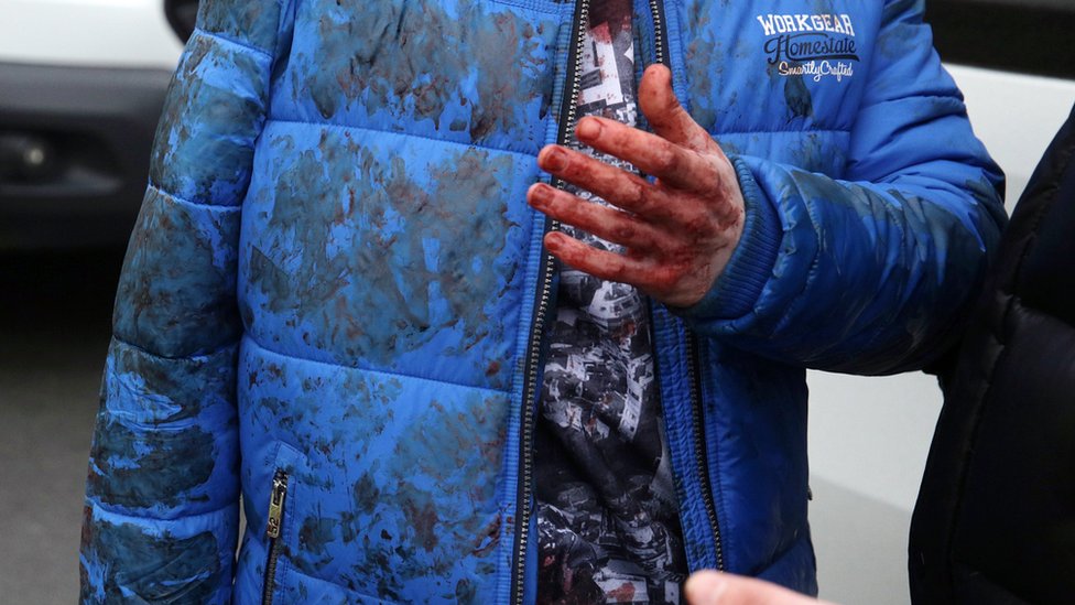 Раненый с окровавленной рукой разговаривает после взрыва на станции метро «Технологический институт» в Санкт-Петербурге