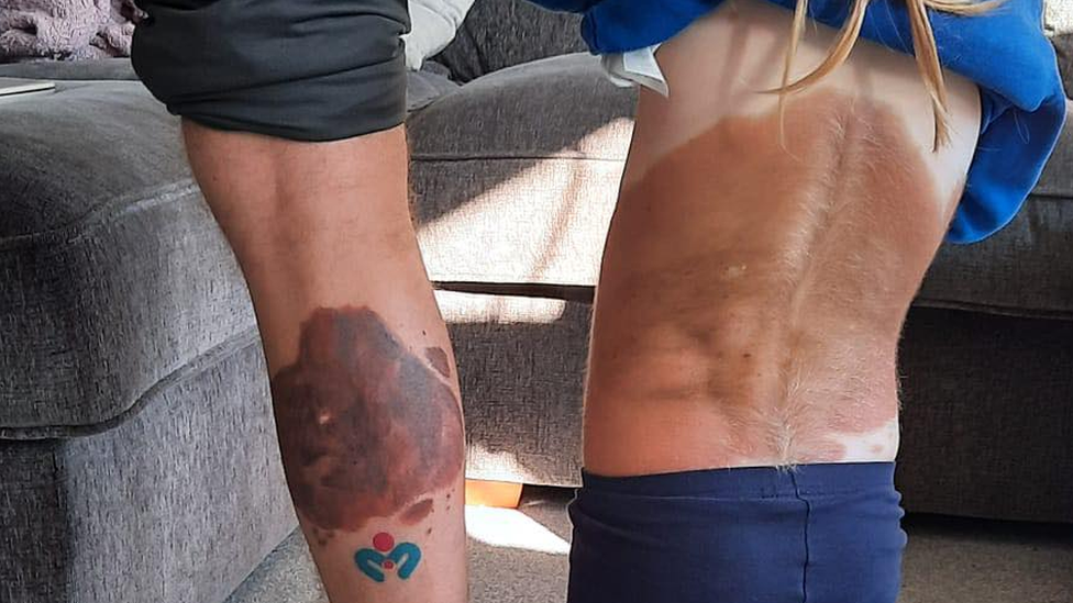 10 People Turned Their Birthmarks Into Tattoos  DeMilked