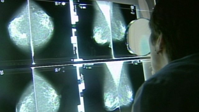 breast augmentation video diary