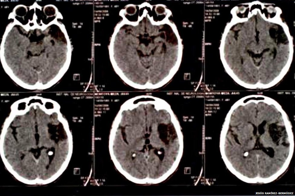 Daño cerebral en un paciente con síndrome de Cotard (Foto: Jesus Bermudez-Ramirez) Daño cerebral en un paciente con síndrome de Cotard (Foto: Jesus Bermudez-Ramirez)
