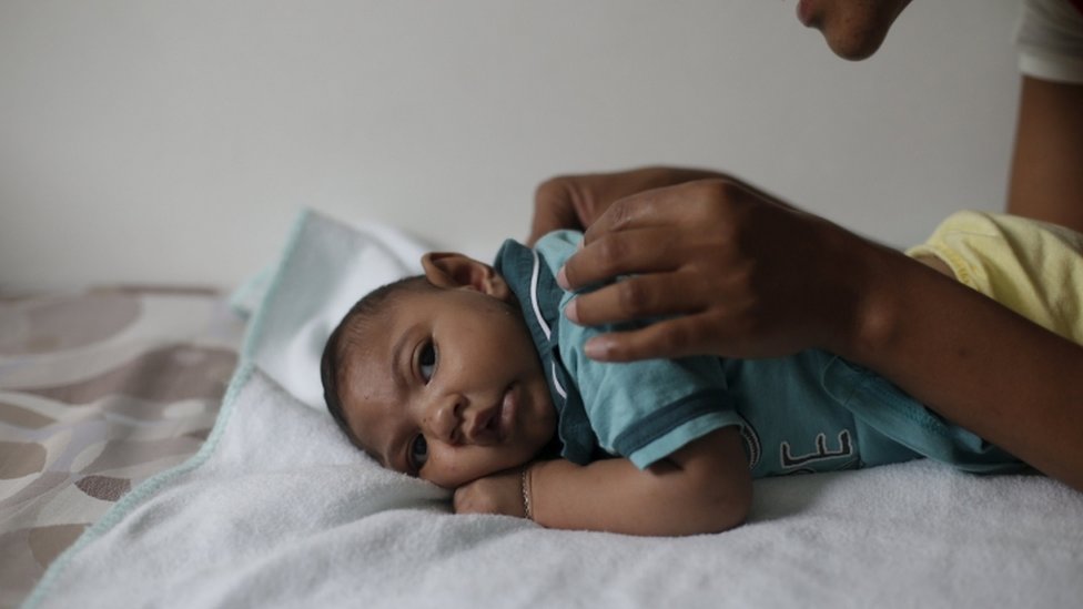 طفل يعاني من صغر الرأس بسبب إصابة بفيروس زيكا