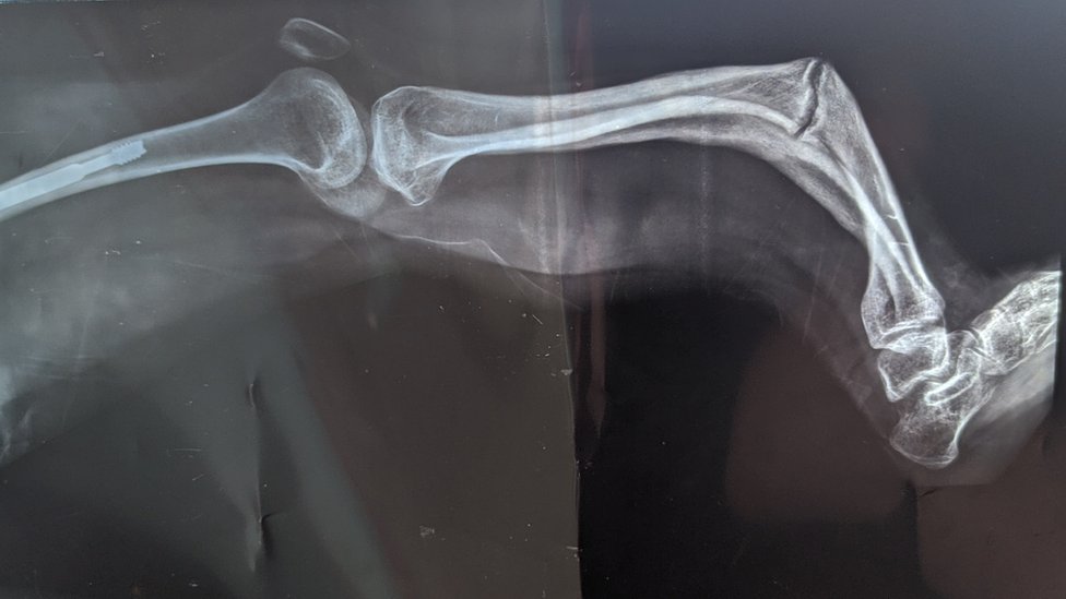 Radiografía de la pierna fracturada de Beatriz.