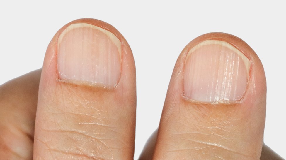 Frágiles, amarillentas o con manchas blancas: cuáles son las anomalías y  problemas más frecuentes de las uñas - BBC News Mundo