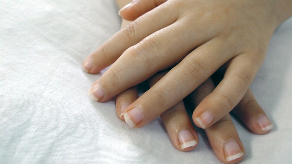 Manos de niña de 5 años con artritis