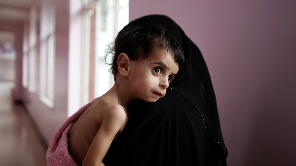 Женщина держит своего истощенного мальчика после того, как его взвесили в отделении интенсивной терапии недоедания в Сане, Йемен, 27 сентября 2016 года.