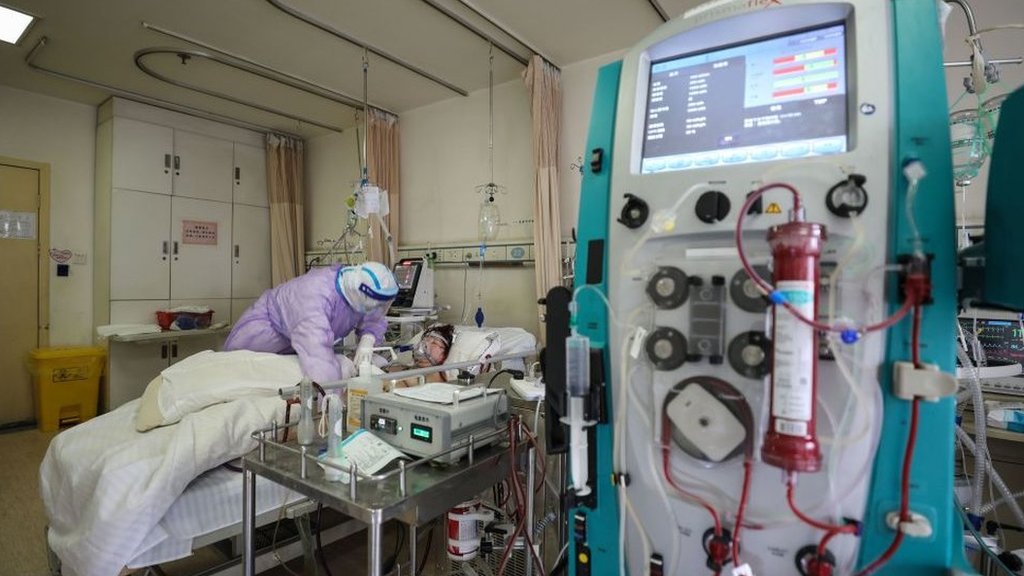 Un paciente de covid-19 conectado a una máquina de ECMO en China