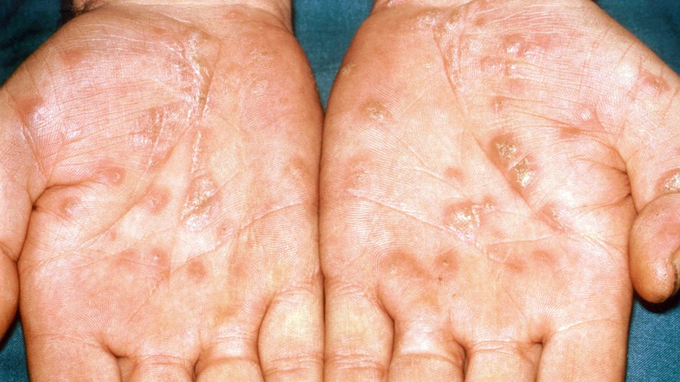 Syphilis Rash On Hands