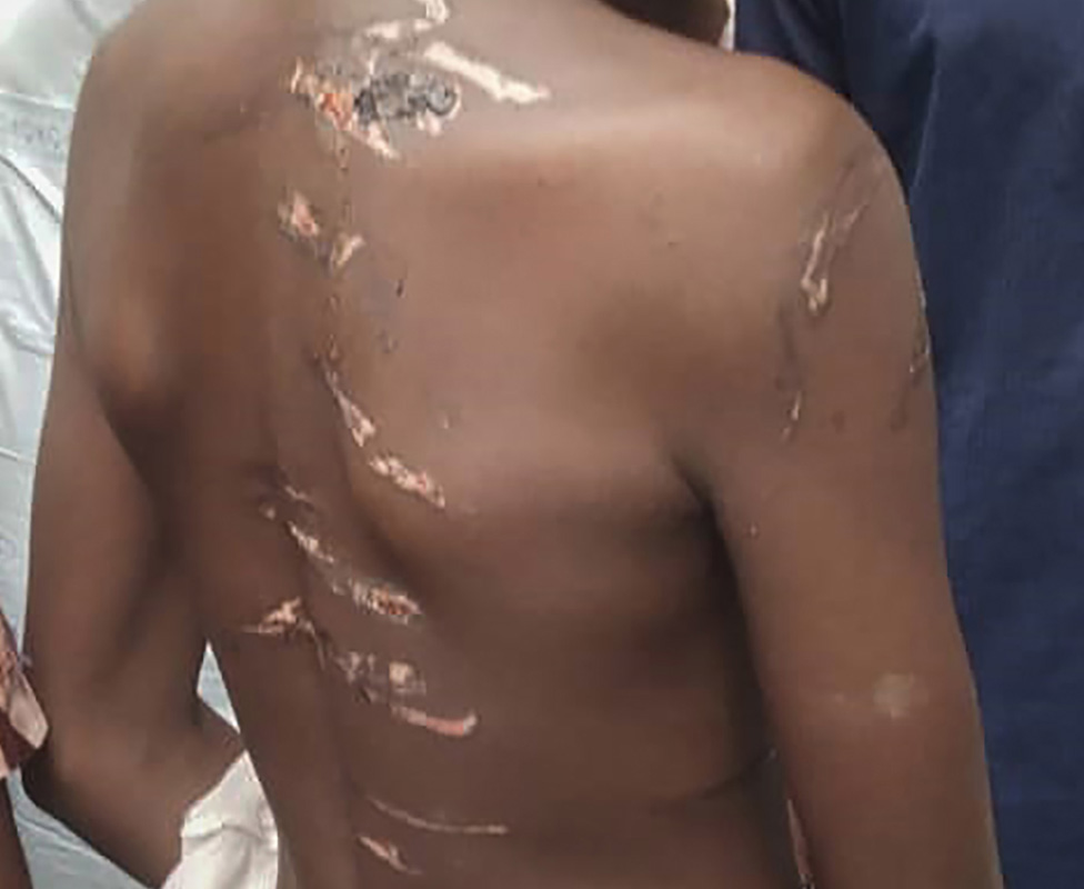 Joven muestra sus marcas en la espalda tras ser golpeado, Rigasa, Kaduna, Nigeria