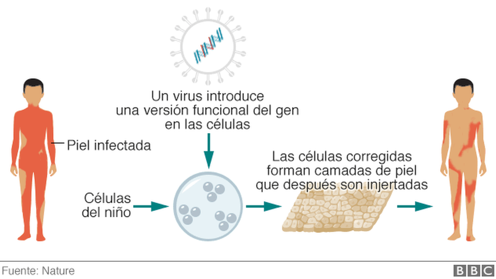 Se necesitaron 3 operaciones para poder cubrir el 80% del cuerpo. Ilustración que muestra la técnica de crear una nueva piel e injerto.