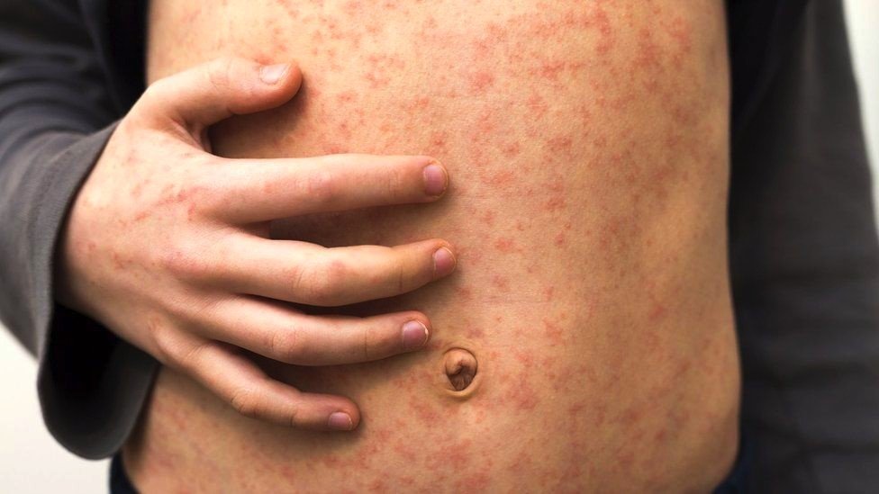 A person with a rash on their abdomen