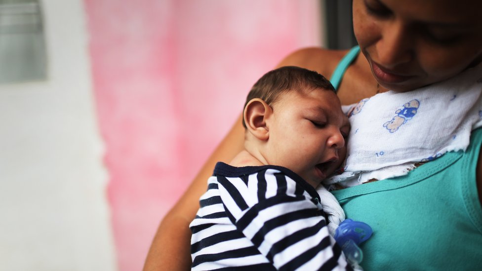 Una madre sostiene a su bebé con microcefalia.