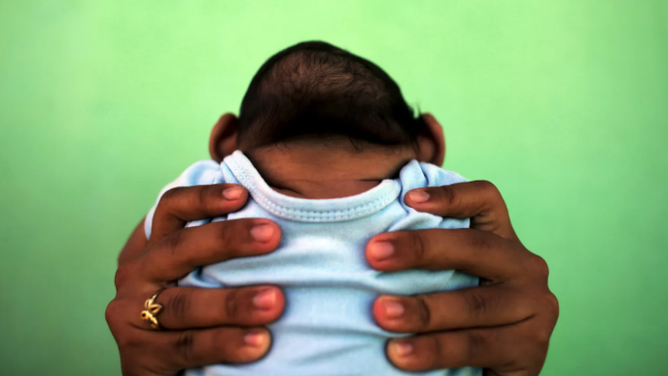 Bebê nascido com microcefalia por conta de síndrome congênita do vírus zika, no Brasil, em 2016