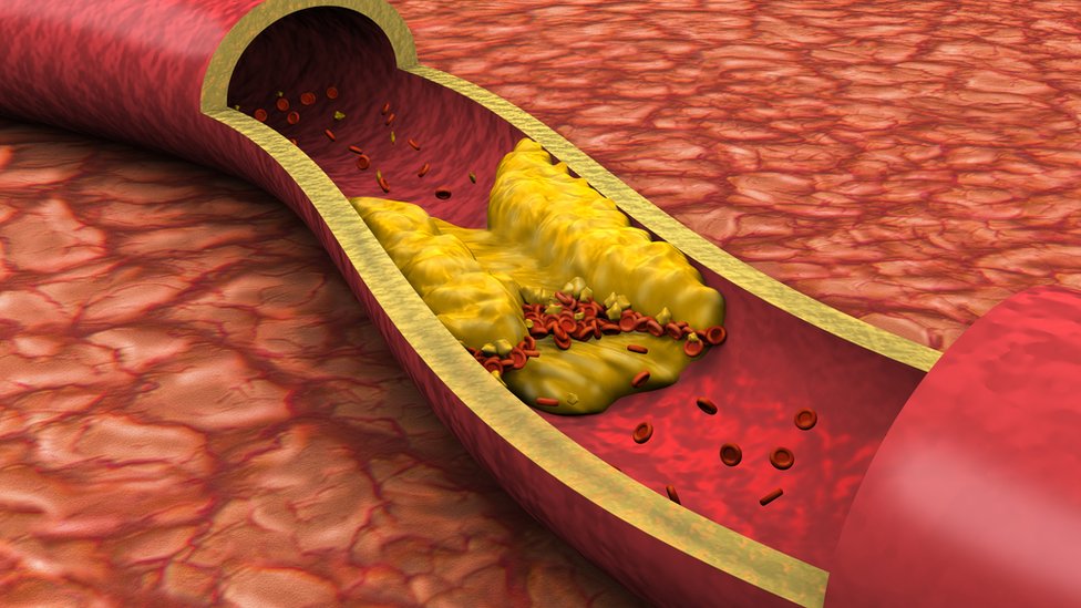 Artéria obstruída por placa de gordura
