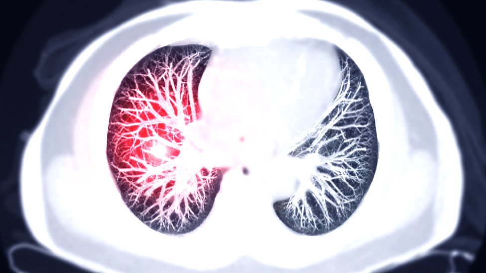 Сканирование легких, показывающее тромбоэмболию легочной артерии