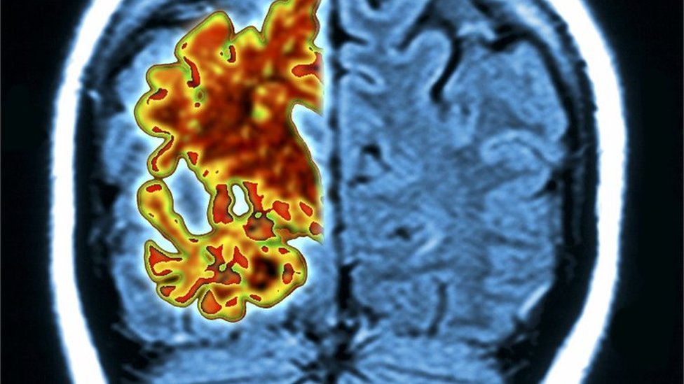 Cérebro de paciente com Alzheimer, mostrando degeneração cerebral