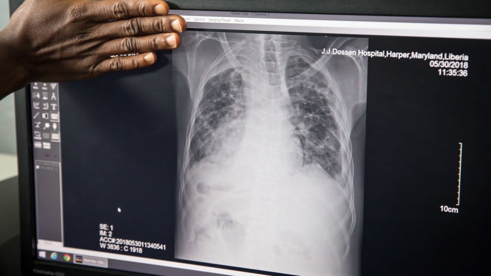 Una radiografía muestra pulmones infectados con tuberculosis