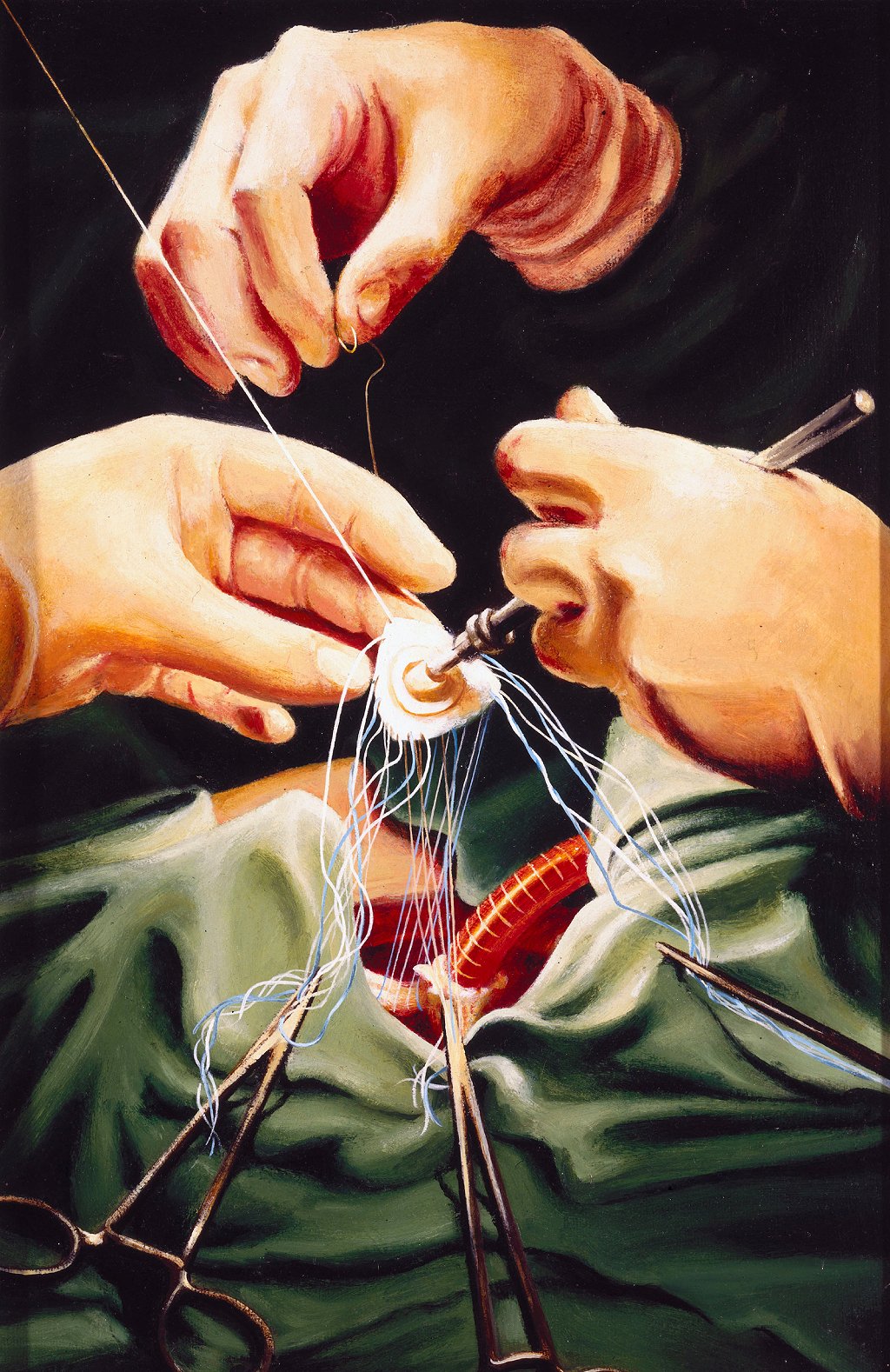 Pintura de Keith Holmes de una válvula de reemplazo lista para ser colocada en el corazón de un paciente. Dos de las tres manos son del Dr. Stephen Westaby; la tercera, de un colega.