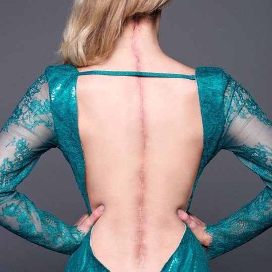 La espalda de Victoria con una cicatriz