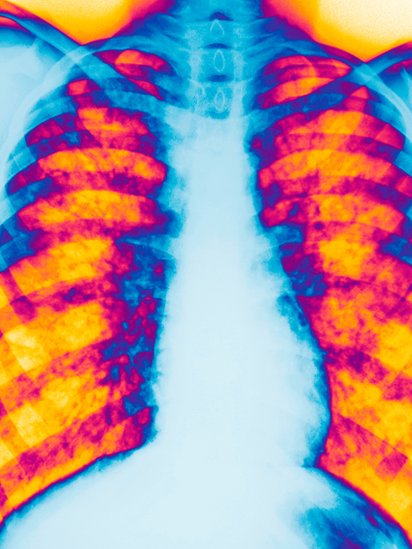 En la mayoría de los casos, la fibrosis quística afecta a los pulmones de los pacientes. Radiografía de una persona con fibrosis quística.