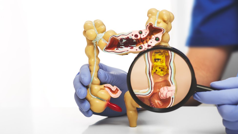 Un modelo del intestino grueso resaltando un divertículo en el sigmoideo