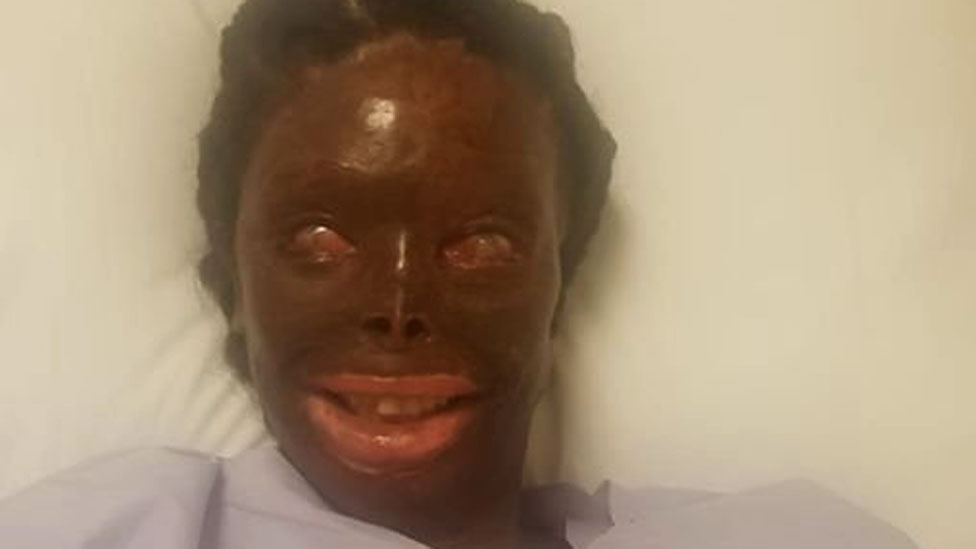 A woman who has survived an acid attack