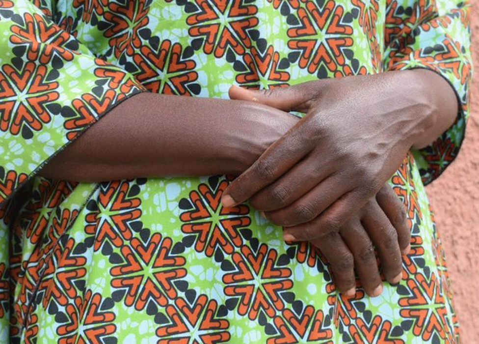 Hand of Carine (not her real name) in Rwanda
