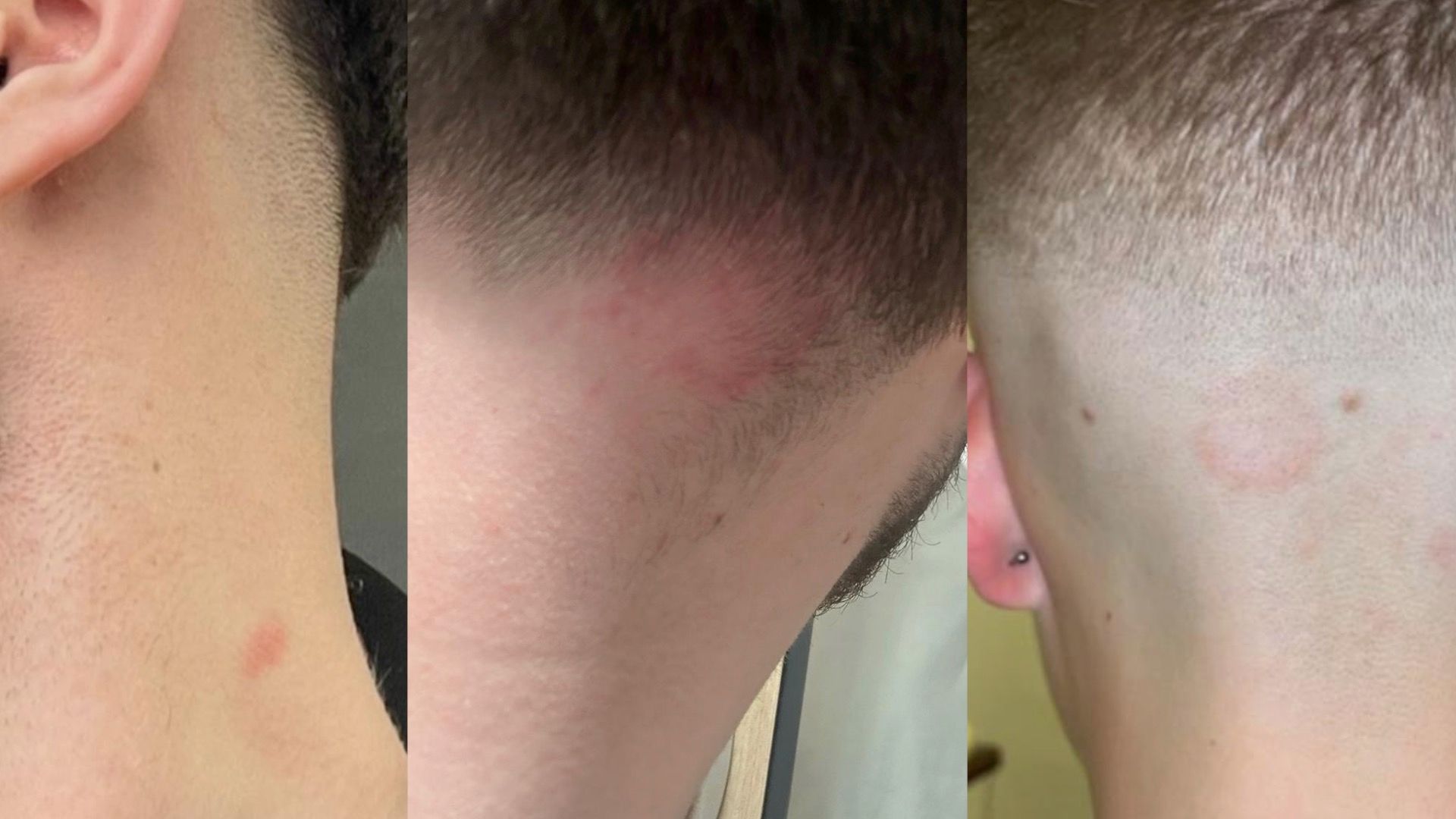 Skin fade warning over ringworm caught at barbers BBC News