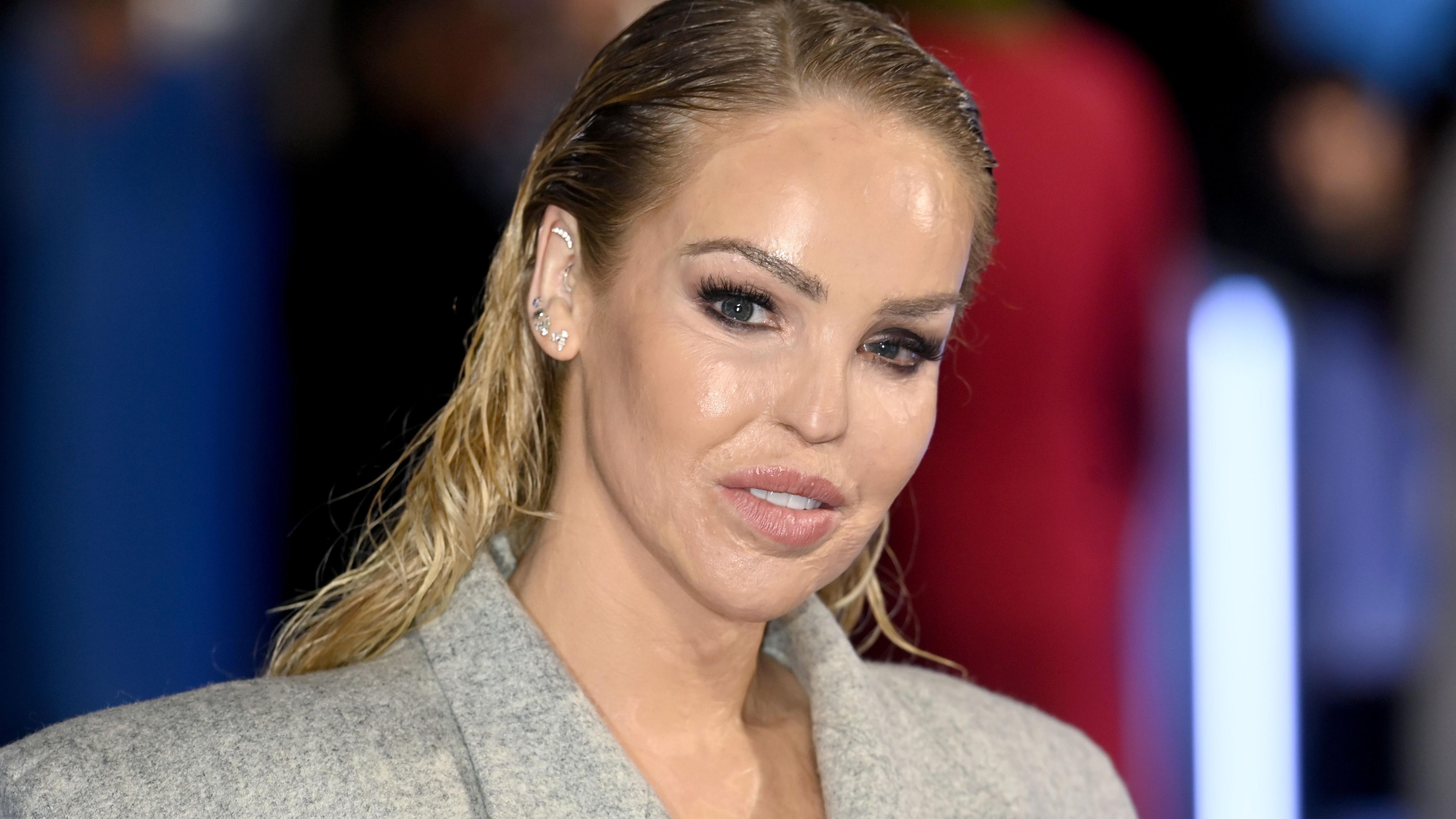 Katie Piper gets 'artificial eye' 16 years after acid attack